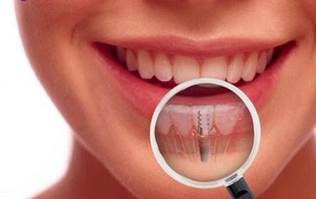 What is a dental implant? How long do dental implants last? Learn more about the implant procedure from the general dentists at Garrison Woods Dental in Marda Loop, SW Calgary.