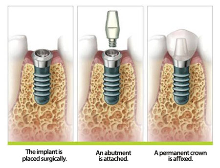 The implant process shown in this diagram shows the steps taken to rebuild a tooth.