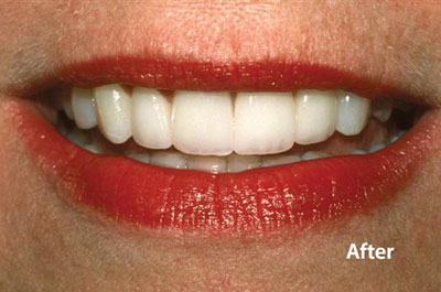 Veneers Calgary, dental veneers provided by a general dentist in SW Calgary in Marda Loop, Garrison Woods at Garrsion Woods dental, including porcelain veneers.