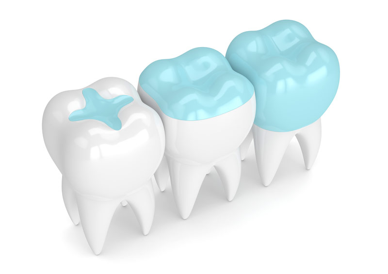 composite fillings by calgary sw dentists in Marda Loop and Garrison Woods